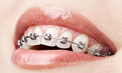 Types of Braces, Amato Orthodontics